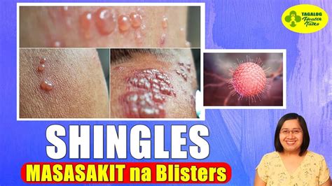 shingles in telugu|Telugu Meaning of shingles